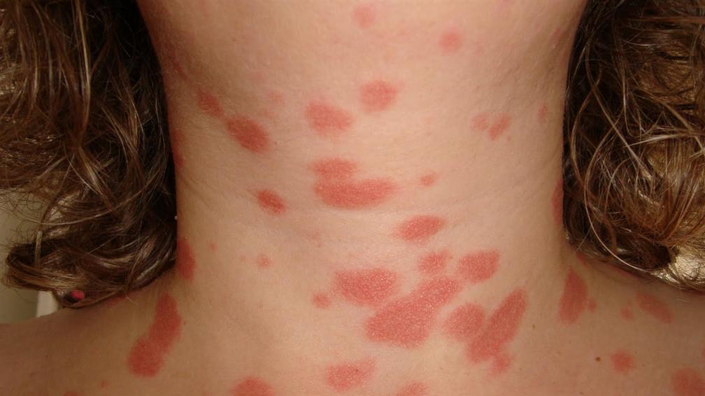 Las vueltas del tratamiento de la psoriasis en izrail